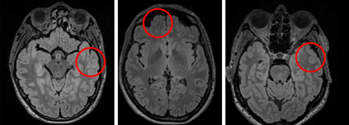 Trzy przekroje mózgu w MRI, na każdym czerwonym okręgiem zaznaczona ogniskowa dysplazja korowa